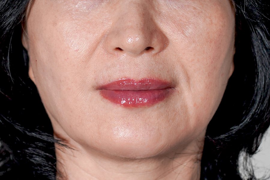 Juvéderm at MILI Clinic Dosan — after, case 1