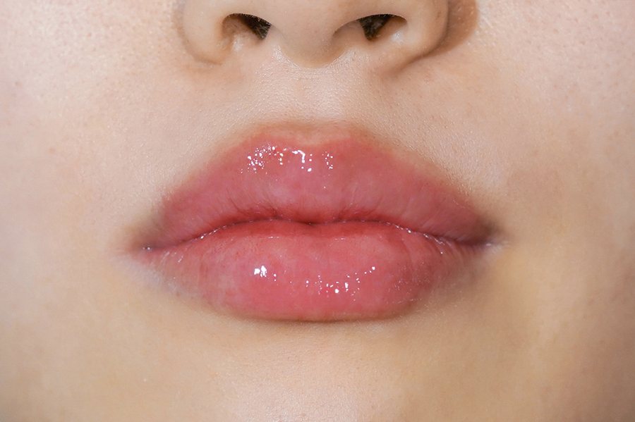 Juvéderm at MILI Clinic Dosan — after, case 2