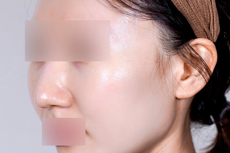 Derma Renewal at MILI Clinic Dosan — after, case 1