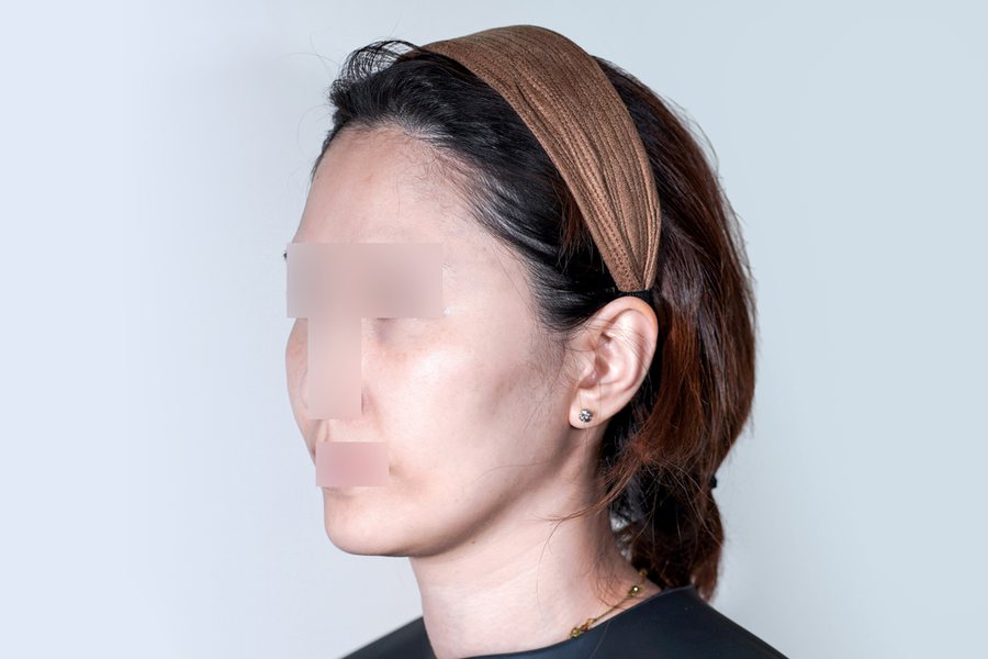Sculptra at MILI Clinic Dosan — before, case 1