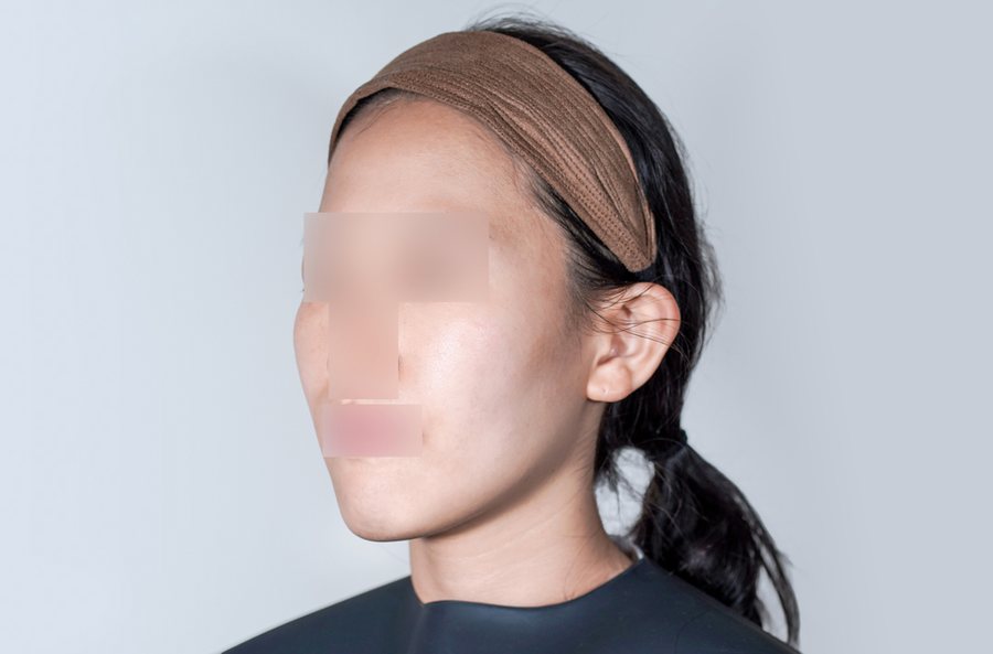Sculptra at MILI Clinic Dosan — before, case 2