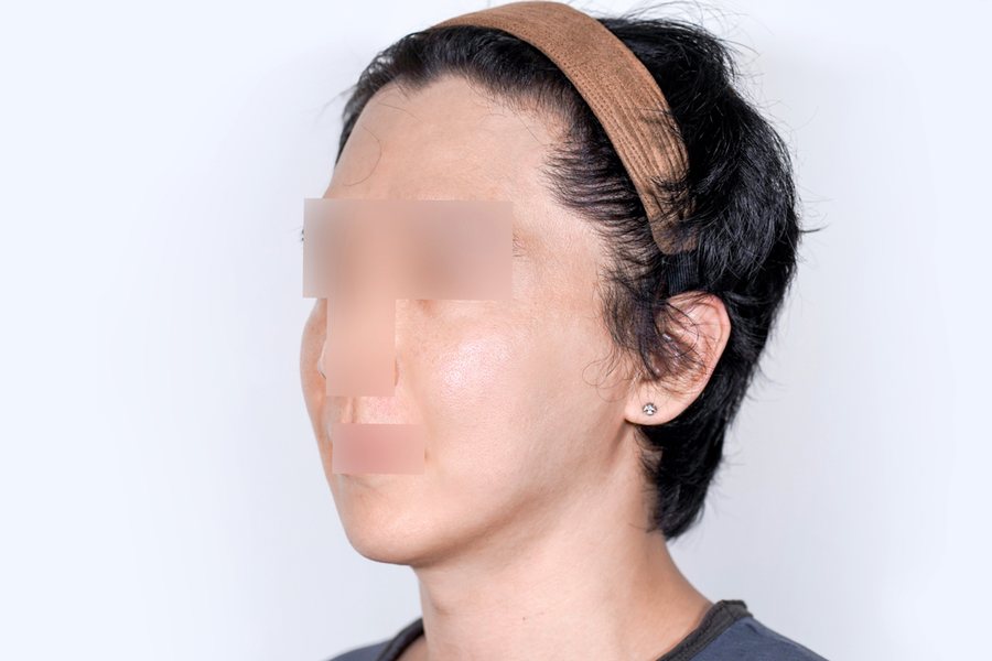 Thermage FLX at MILI Clinic Dosan — after, case 1