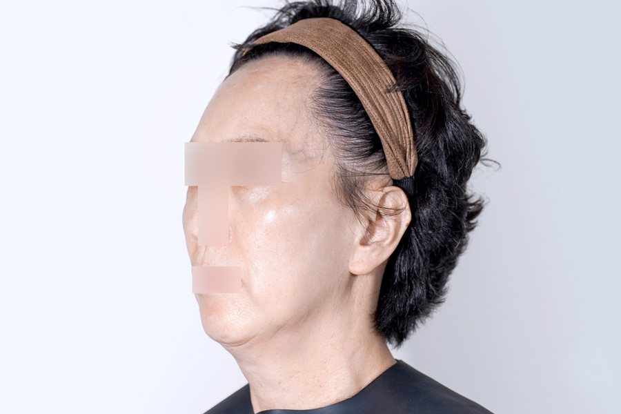 Thermage FLX at MILI Clinic Dosan — after, case 2