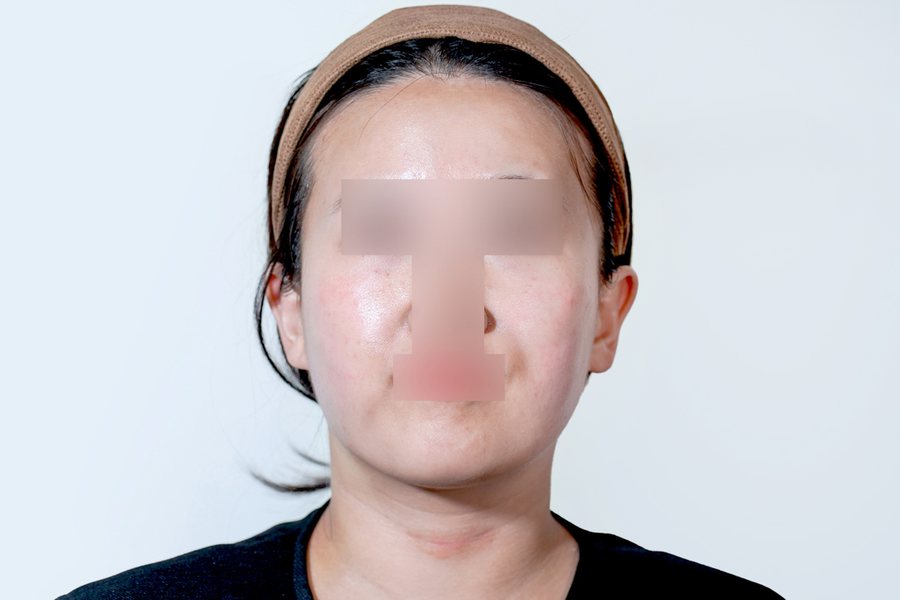 Ultherapy Prime at MILI Clinic Dosan — before, case 2